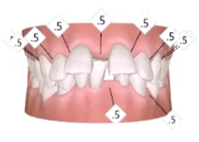 A digital model of misaligned upper teeth with several diamonds labeled .5 pointing to different teeth, indicating measurements or adjustments needed.