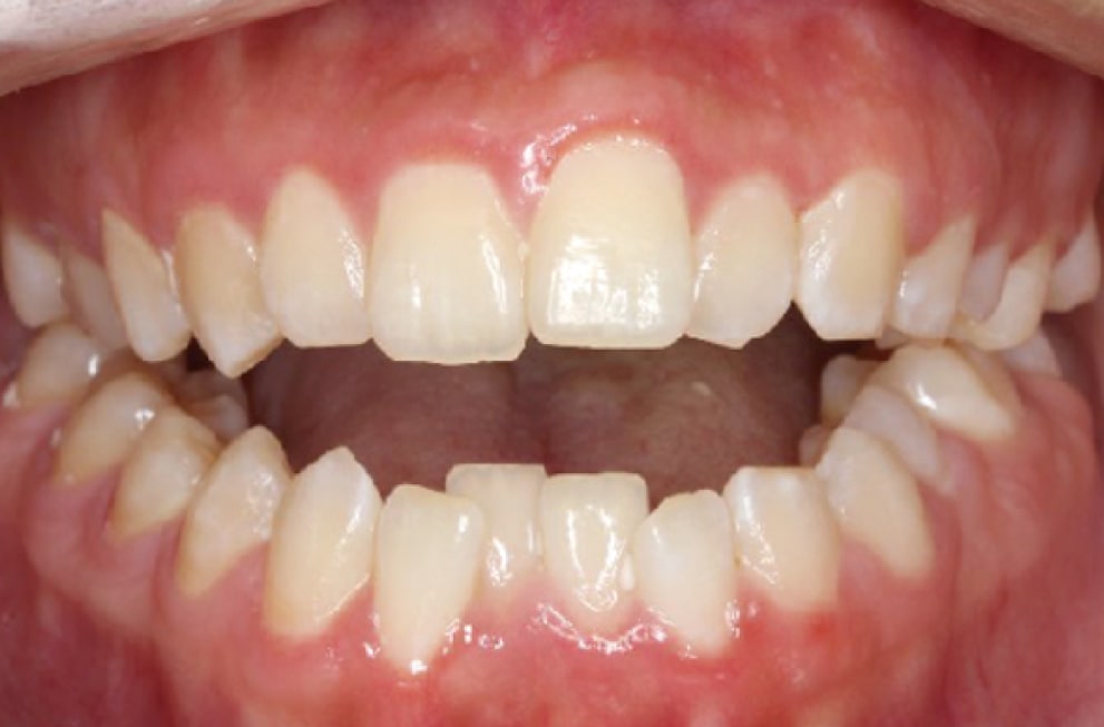 Close-up of an open mouth showing teeth with noticeable gaps and irregular alignment, indicating dental crowding and spacing issues. The gums appear pink and healthy.