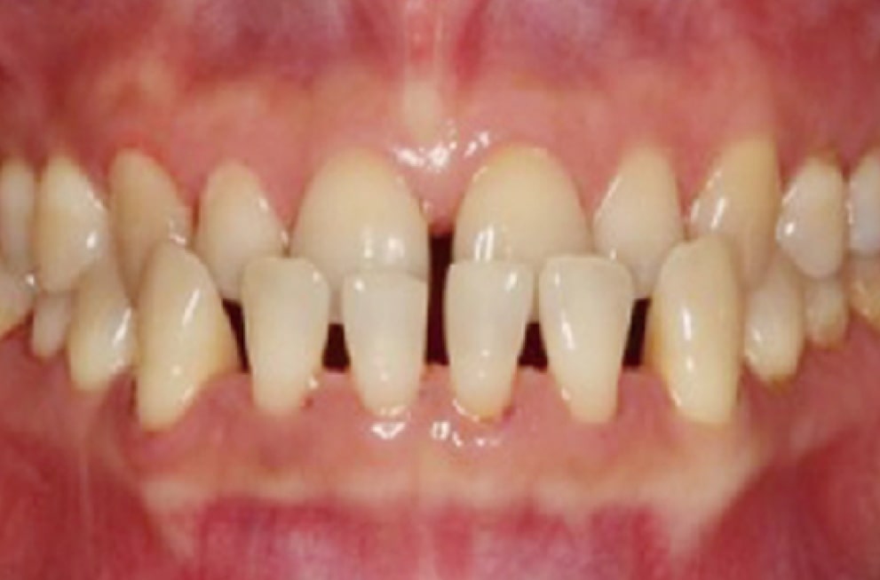 A close-up of a persons upper and lower teeth showing noticeable gaps, gum recession, and uneven tooth alignment. The gums appear red and mildly inflamed.