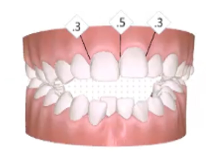A digital illustration of human teeth showing the upper and lower jaws, with numerical labels .3 and .5 indicating measurements on the upper front and side teeth.