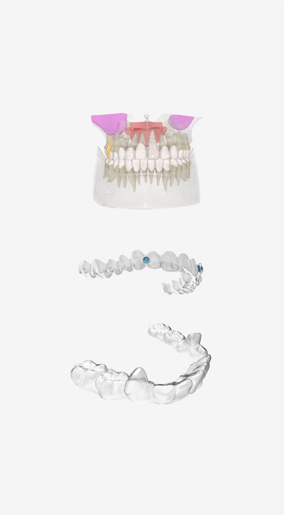 A dental model with colorful parts is shown at the top, with two clear orthodontic aligners positioned below it against a white background.
