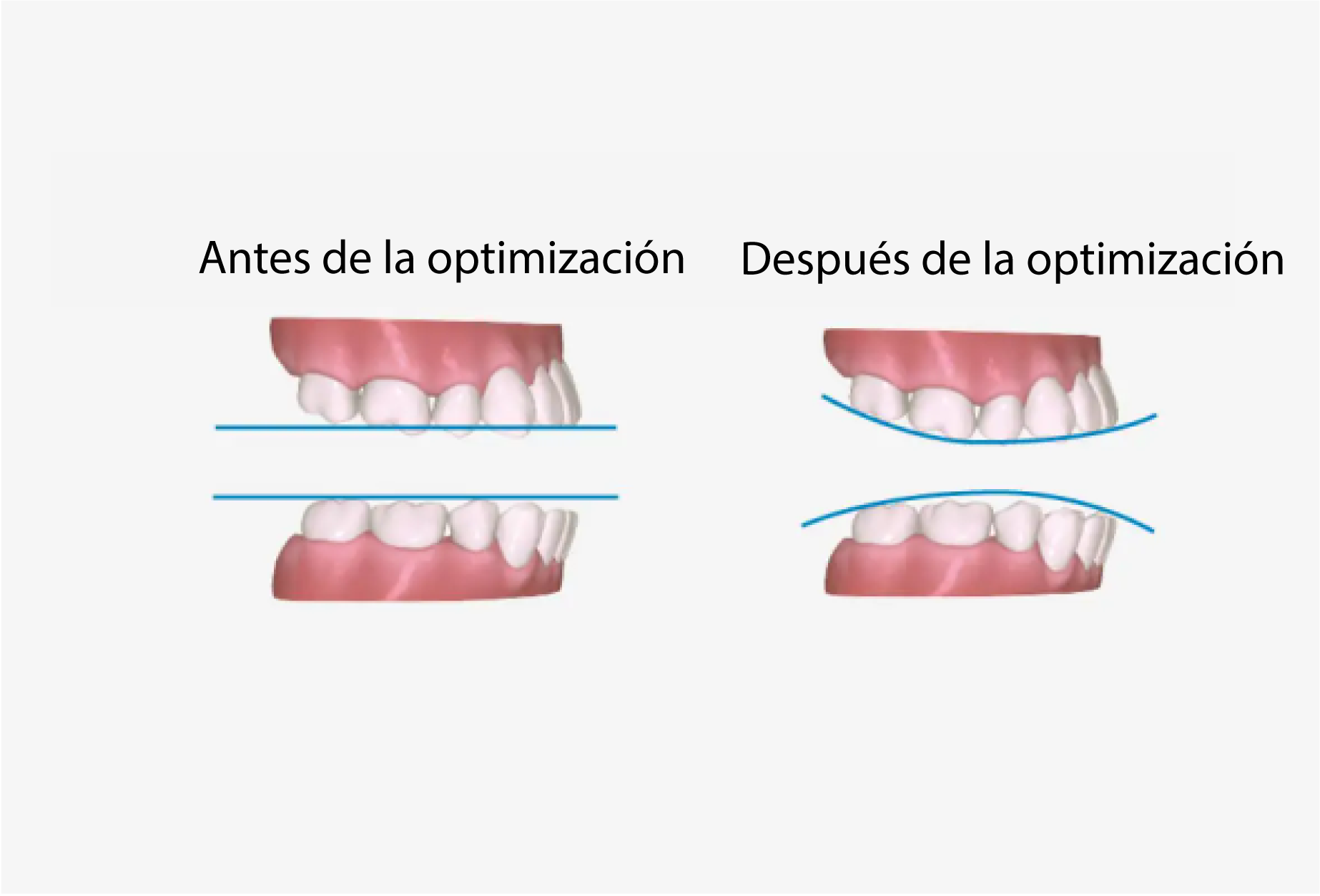 a7-premolar-extraction2_ES