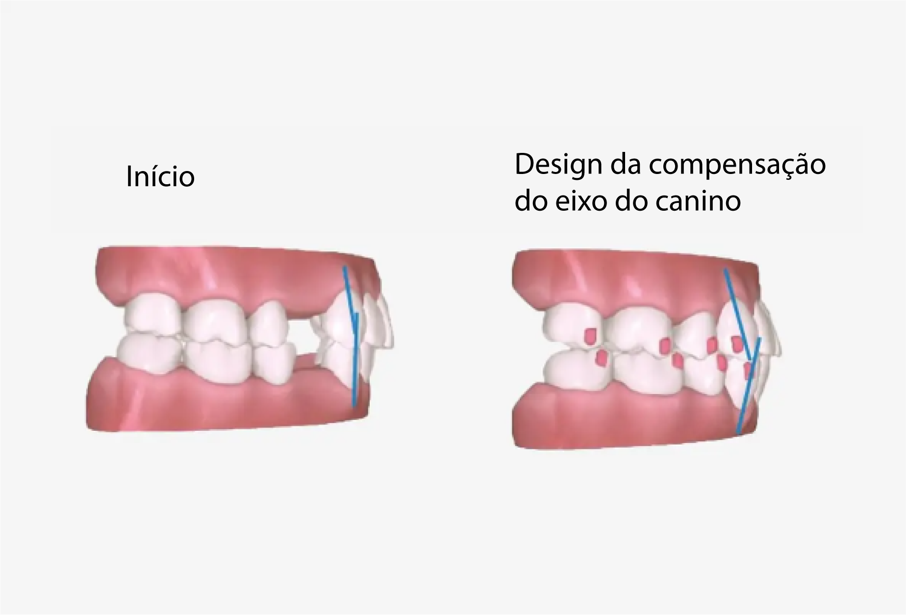 a7-premolar-extraction3_PT
