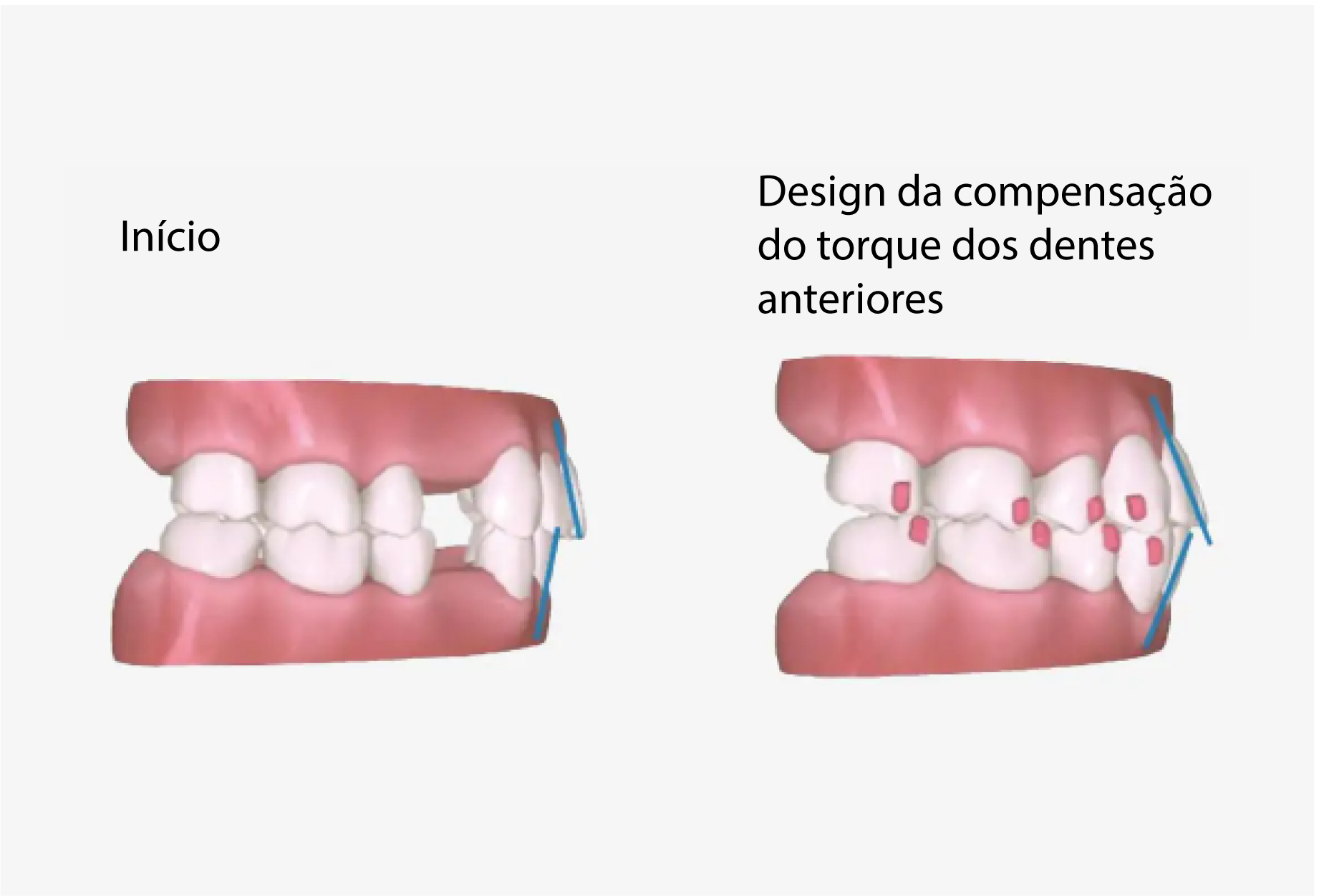 a7-premolar-extraction4_PT