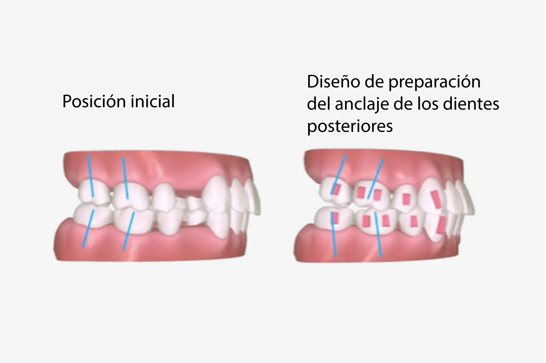 a7-premolar-extraction_ES