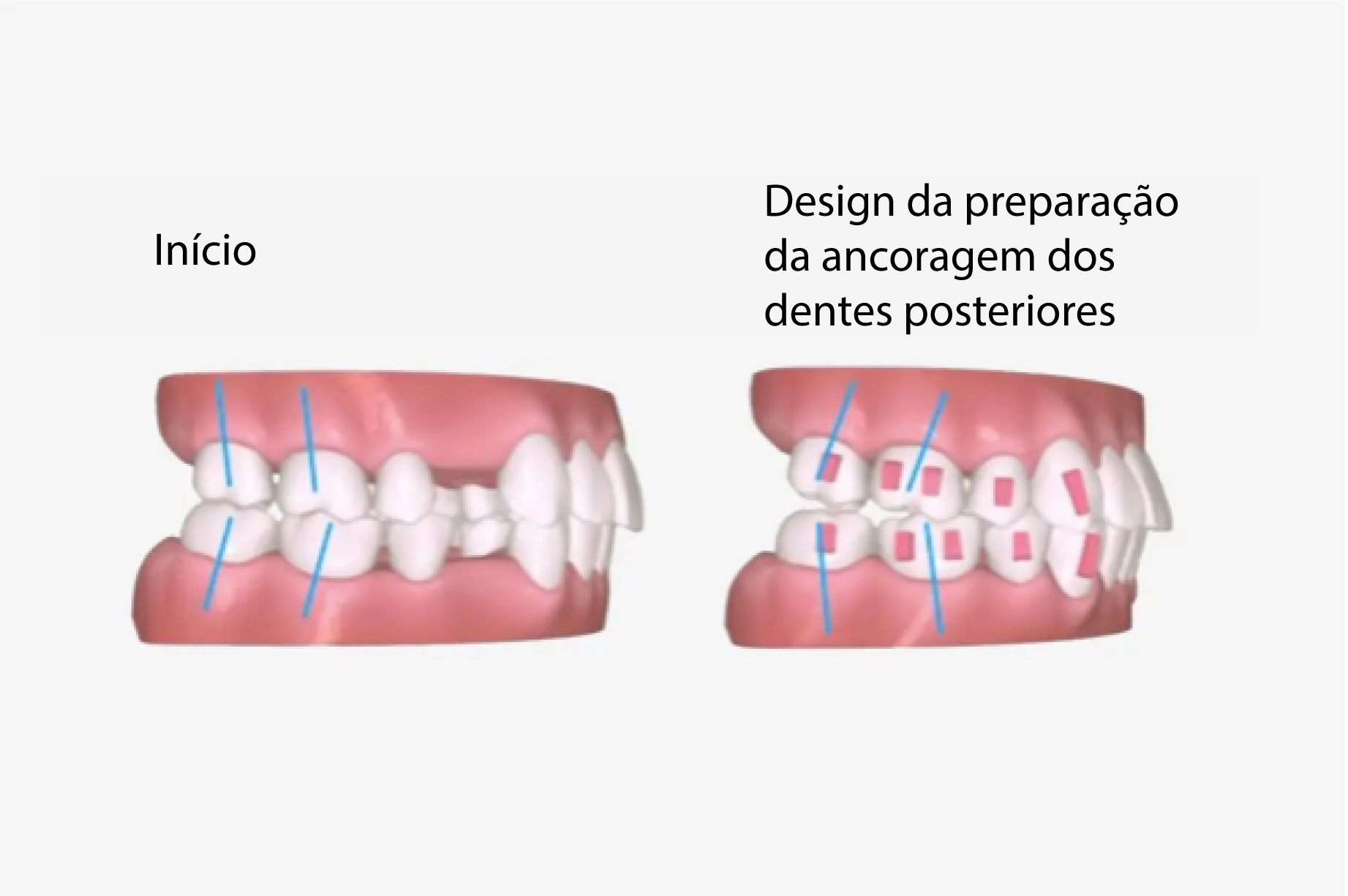 a7-premolar-extraction_PT