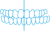Illustration of two sets of teeth aligned side by side with a vertical blue line dividing them down the middle, highlighting differences in alignment or symmetry.