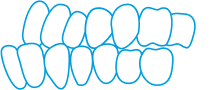 Diagram of two rows of teeth, representing an overbite where the upper teeth significantly overlap the lower teeth.